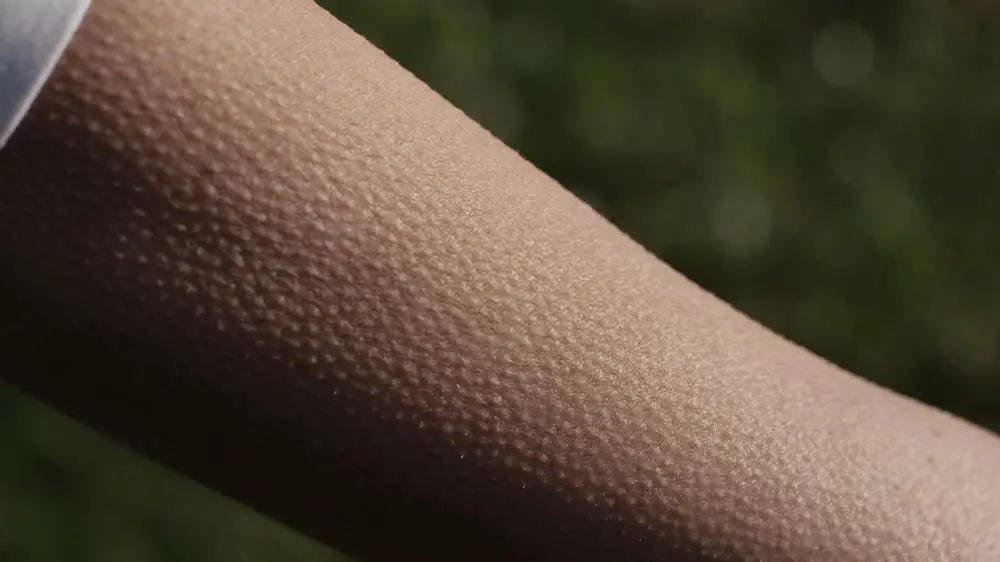 Goosebumps with no hair